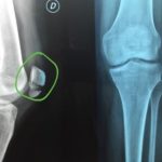 Innovador “pegamento” óseo inspirado en ostras podría revolucionar la recuperación de fracturas