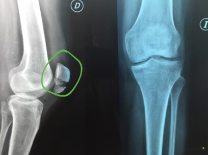 Innovador “pegamento” óseo inspirado en ostras podría revolucionar la recuperación de fracturas
