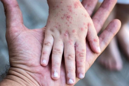 Alta movilidad poblacional y baja cobertura de vacunación contra sarampión ponen en riesgo estatus sanitario de México: especialista de la UASLP